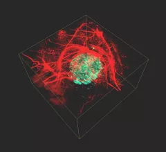 Photoacoustic tumor image