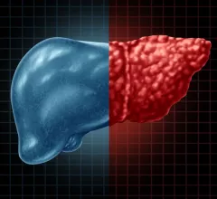 fatty liver disease hepatic steatosis 