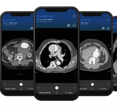 Examples of CT imaging showing aortic dissections on an acute AAA response team app that was recently cleared by the FDA from Viz.AI. 