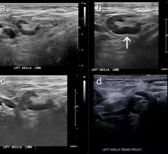 An example of COVID vaccine caused axillary adenopathy. The woman has a family history of breast cancer, but this lesion, seen on breast ultrasound, tested negative in an RSNA study.