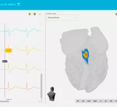 The Vektor Medical vMap system takes standard 12-lead ECGs and converts them into detailed electro anatomical maps for us in catheter ablation procedures.