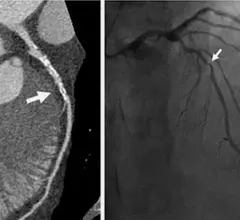 An example of a noninvasive coronary CT scan on the left and an invasive angiogram of the same patient on the right from a recent RSNA study. The CT shows more information on the calcified nature of the plaque and shows more anatomical information beyond what the angiogram provides.
