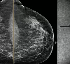 An example of a mammogram with some dense breast tissue that was deemed to not have cancer, and molecular breast imaging (MBI) study of the same women showing increased metabolic activity in the dense area, revealing a caner. Image from Mayo Clinic.