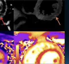 Top cardiology stories in Cardiology Business magazine in February 2022. The top stories this month included new information on COVID vaccine caused myocarditis and the FDA clearance of the first transcatheter dual-chamber leadless pacemaker system from Abbott.