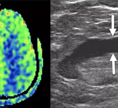 Two top stories radiology this past month was the nuclear imaging isotope shortage and an ultrasound imaging study of COVID vaccine adenopathy.