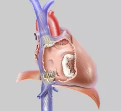 TricValve Transcatheter Bicaval Valves System Cleveland Clinic