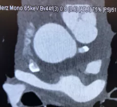 Cardiac CT imaging has been moved to the forefront of medical imaging to evaluate chest pain under the new 2021 chest pain guidelines from the AHA and ACC. #Yescct #CCTA #CTA #CT