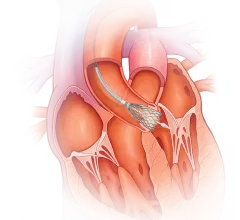 TAVR Medtronic Evolut EXPAND TAVR II Pivotal Trial,