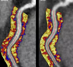 xPerivascular fat attenuation index CT scans from a drug study showing a reduction in coronary wall inflammation. This measure is being tested in trials to see if it can accurately predict which coronary artery lesions will progress to cause heart attacks. The method also can show a reduction in risk with therapy, as seen here.