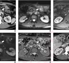 Photo and caption courtesy of American Journal of Roentgenology (AJR), American Roentgen Ray Society (ARRS). Used with permission.