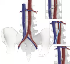 The steps involved to gain transcaval access between the inferior vena cava and the aorta to avoid problematic anatomical areas that would have otherwise disqualified a patient for a femoral access TAVR procedure. Illustration of the NIH