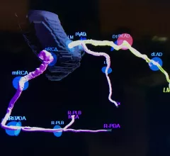 AI-generated coronary tree from a patient's CT scan showing a color code of areas of interest for plaque burden from the Cleerly software shown at SCCT 2022.