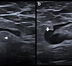 differentiating between malignant and vaccine-related lymphadenopathy