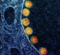 COVID from a patient's nasal passage. Transmission electron micrograph of SARS-CoV-2 virus particles (gold) within endosomes of a heavily infected nasal olfactory epithelial cell. Image captured at the NIAID Integrated Research Facility (IRF) in Fort Detrick, Maryland. Image courtesy of NIAID. What does COVID look like?