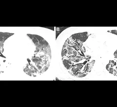 Patient with severe, lung damage from COVID. Images in a 54-year-old man with COVID-19–related acute respiratory distress syndrome and subsequent fibrosis. (A) Axial CT 2 weeks after admission shows diffuse ground-glass opacity (GGO) with reticular abnormality and traction bronchiectasis in right middle lobe, indicating organizing phase of lung injury. (B) Axial CT 6 months after admission shows decreased GGO but extensive traction bronchiectasis and architectural distortion, suggesting fibrosis. RSNA