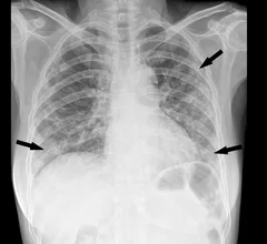 Chest radiograph in a 53-year-old woman with confirmed coronavirus disease 2019, or COVID-19, pneumonia. The patient had fever and cough for 5 days. Multifocal patchy opacities (arrows) can be seen in both lungs. Image courtesy of RSNA. What COVID looks like ob CT medical imaging.