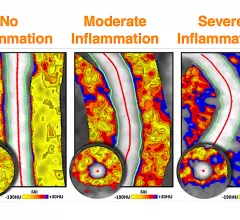 Fat attenuation index (FAI) CT imaging of coronary artery fat can show inflammation and can help pin-point vulnerable plaques, or show the reversal of inflammation due to drug therapies. The technology is being developed by the vendor Caristo, which has European CE mark and the company is seeking FDA clearance. #SCCT #SCCT2022