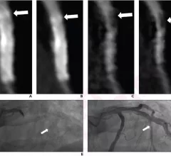 coronary CTA