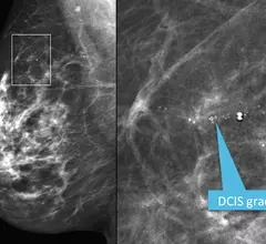 Mediolateral oblique view from a screening mammogram in a 54-year-old woman shows a small cluster of microcalcifications in the upper outer quadrant of the right breast. The right image shows a detailed spot magnification view of the calcifications. Stereotactic biopsy revealed grade 2 ductal carcinoma in situ (DCIS). RSNA image. Image of breast micro calcifications associated with breast cancer.