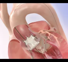 JenaValve Technology transfemoral TAVR