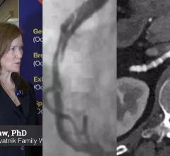 Leslee Shaw, PhD, MSCCT, FACC, MASNC, FAHA, director of the Blavatnik Family Women's Health Research Institute, a professor of medicine at the Icahn School of Medicine at Mount Sinai, and a former president of both SCCT and ASNC. She explains the sex differences in cardiovascular imaging presentations in women versus men. 