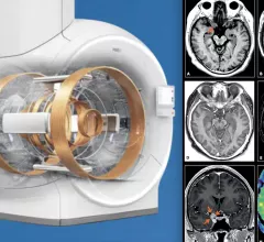 MRI system advances include helium-free MRI systems (left is Philips version of this system), and compressed sensing (right, GE's version of this technology), which can greatly reduce scan times. Both technologies were mentioned in an overview by Signet Research of new tech that will be at RSNA 2022. 
