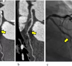 subtraction coronary CT angiography