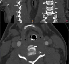 cerebrovascular injury #traumaimaging #vascularimaging #vascularinjury