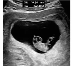 As the pregnancy advances, the embryo is easier to see, and accurate measurements can be obtained with transabdominal ultrasound. A crown-rump length (CRL) measurement. This ultrasound scan shows the CRL, which is the average of discrete fetal measurements from the tip of the head end to the tip of the rump end in the midsagittal plane of the embryo. This is highly accurate for pregnancy dating. Images courtesy of RSNA