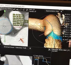 An example of virtual pulmonary valve implant planning software showing a virtual transcatheter pulmonary valve with measurements implnated in the virtual anatomy of a congenital heart patient. This was part of a training class at the Society of Cardiovascular Computed Tomography (SCCT) 2022 meeting.