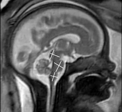MRI image of a fetus inside the mother on an MRI scan to assess brain development. Image courtesy of RSNA.