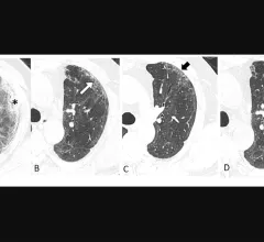 Serial transverse CT scans in a 65-year-old man with severe COVID-19. Image courtesy of Radiology. #longcovid #covidlonghauler #lungdamagecovid