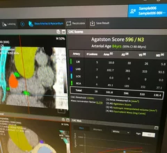 An example of artificial intelligence automated coronary artery calcium scoring shown by Coreline at ACC23. The AI also identifies and color codes the anatomy so help show the reviewing radiologist or cardiac imager what and where things were calculated. #ACC #ACC23