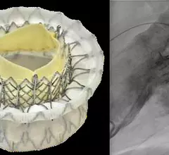 The Cephea transcatheter mitral valve in development has been acquired by Medtronic.
