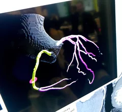 Example of an automated artificial intelligence (AI) assessment of soft coronary plaque from a CT scan from the vendor Cleerly. This image shows the AI's reconstruction of a patient's coronary tree and color codes the vessel segments by the amount of overall plaque burden. The AI gives a very detailed report of all the plaque in all the coronary vessels. Some cardiology experts believe this may be the way of the future in screening patients for early coronary disease and monitoring the impact of prevention