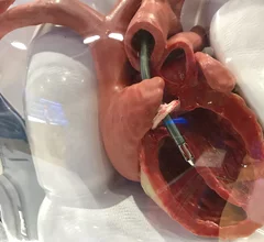 Model in the Abiomed booth showing placement of the Impella 5.5 liters per minute catheter heart pump. This is used for patients who need more support than a conventional Impella CP can offer, but does not require level of supported from ECMO.