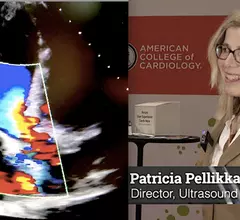 Echocardiography expert Patricia A. Pellikka, MD, discussed the trend of increasing artificial intelligence (AI) integration in cardiac ultrasound with Cardiovascular Business at American College of Cardiology (ACC) 2023 meeting.
