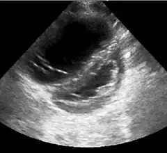 A figure from the ASE pediatric POCUS guidelines showing parasternal short-axis view demonstrating RV dilatation with bowing of the septum into the left ventricle, indicating pulmonary hypertension in this child with shock and pertussis.