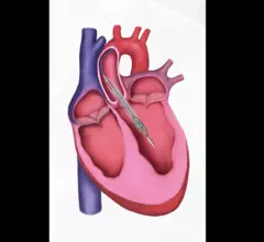 Magenta Medical Elevate Heart Pump