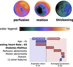 Part of the graphical results from the Cedars-Sinai AI cardiac risk assessment tool from basic data like the patient’s age, gender, weight, heart rate, and blood pressure, and AI interpretation of cardiac imaging.