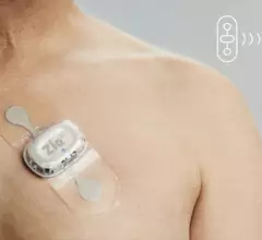 Zio AT mobile cardiac telemetry device