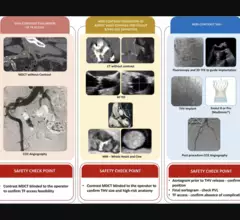 No contrast transcatheter aortic valve replacement