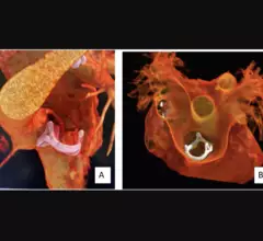 Image of a bioprosthetic valve within the RVOT from the SCCT's congenital heart disease guidelines