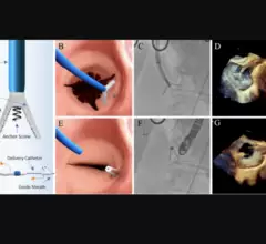 K-Clip annuloplasty system for tricuspid regurgitation by Shanghai Huihe Medical Technology Co. 