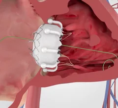 Edwards Evoque transcatheter tricuspid valve replacement TTVR