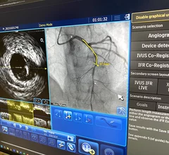IVUS with coregistration with angiography displayed by Philips at TCT 2023. Photo by Dave Fornell