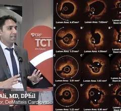 Ziad Ali, MD, explaines the impact of coronary intravascular lithotripsy (IVL) use in nodular and eccentric calcium morphologies at TCT 2023. IVL was found to produce better outcomes than atherectomy or high pressure balloons. #TCT #TCT2023 #TCT23 #IVL 