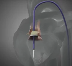 Pi-Cardia ShortCut TAVR device
