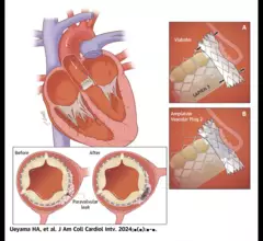 Overview of the Tootsie Roll technique for treating paravalvular leak in certain transcatheter heart valve patients. Tootsie Roll paravalvular leak transcatheter heart valves.