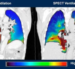 AI software improves diagnosis of lung conditions when contrast cannot be used